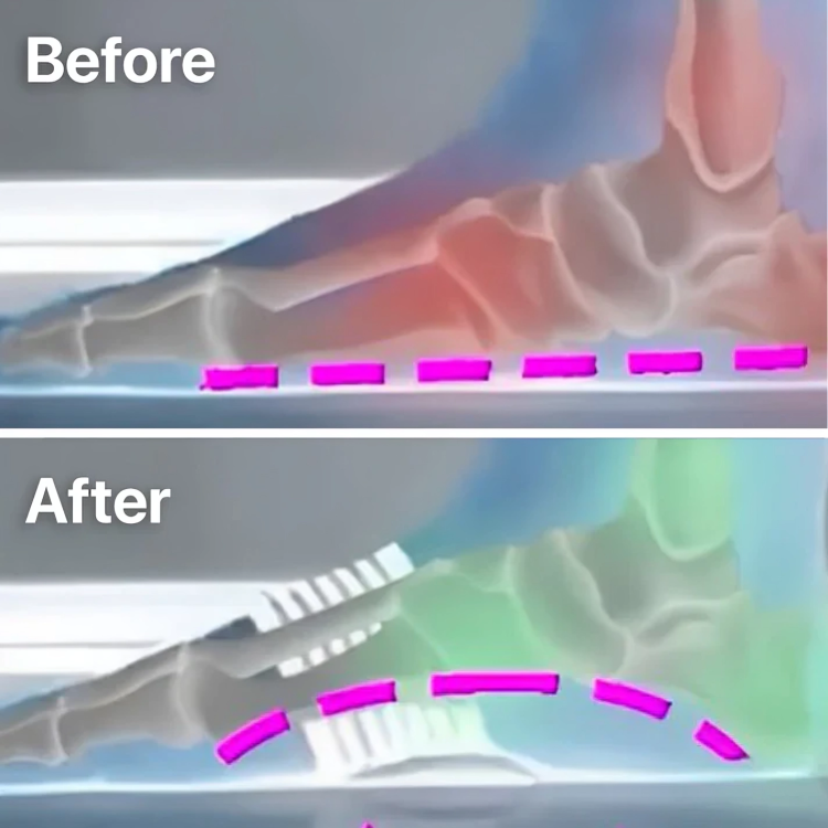 StepRelief™ | Orthopädische Fußgewölbestütze