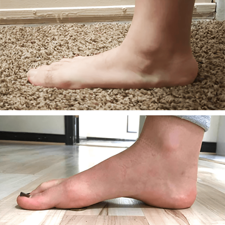 StepRelief™ | Orthopädische Fußgewölbestütze
