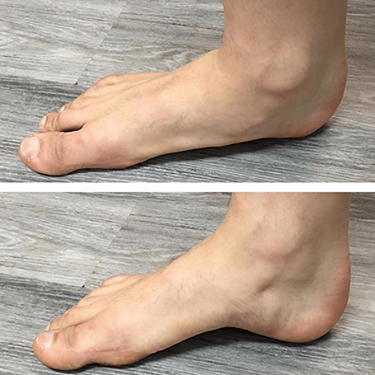 StepRelief™ | Orthopädische Fußgewölbestütze
