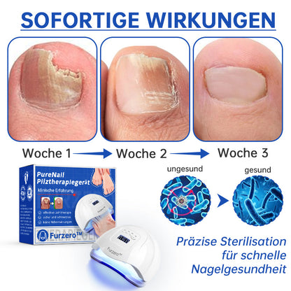 PureNail™ | Nagelpilz-Lasertherapiegerät