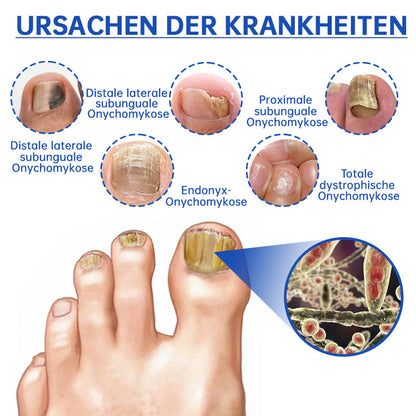 PureNail™ | Nagelpilz-Lasertherapiegerät