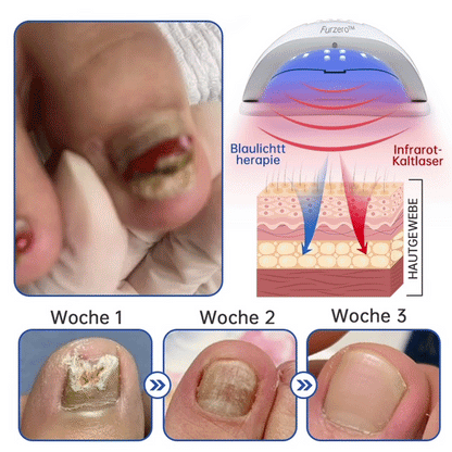 PureNail™ | Nagelpilz-Lasertherapiegerät