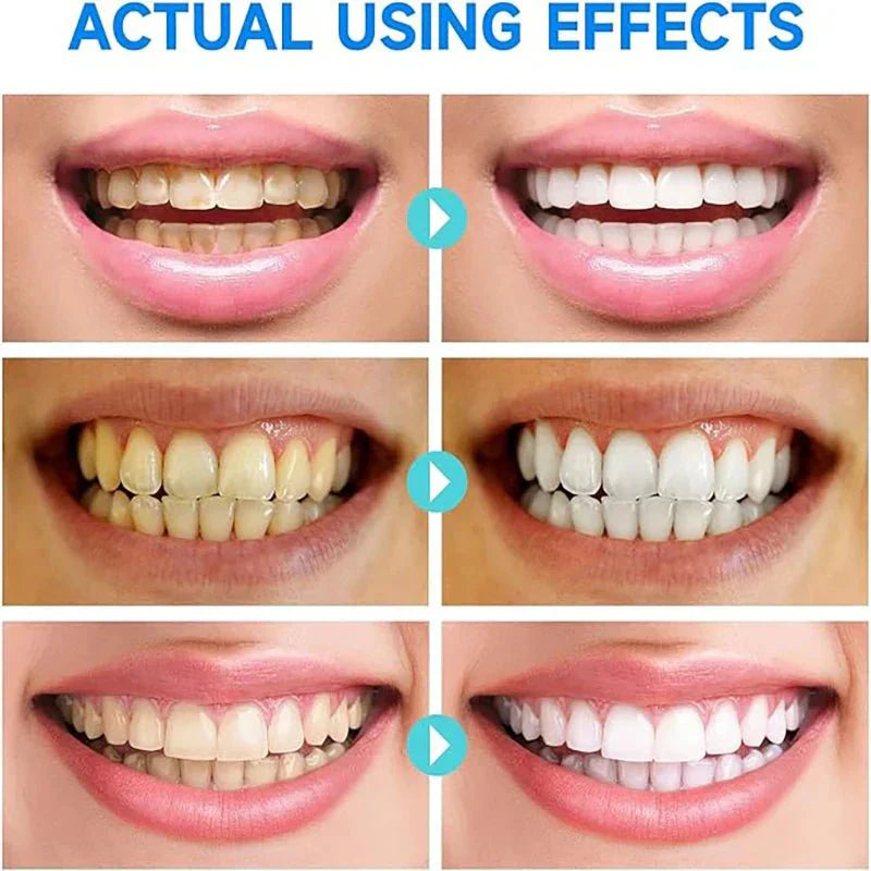 BrightMolto – Schnelle Zahnaufhellung, Heilung des Zahnfleisches & Erfrischung des Atems