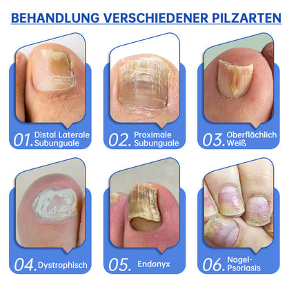 PureNail™ | Nagelpilz-Lasertherapiegerät