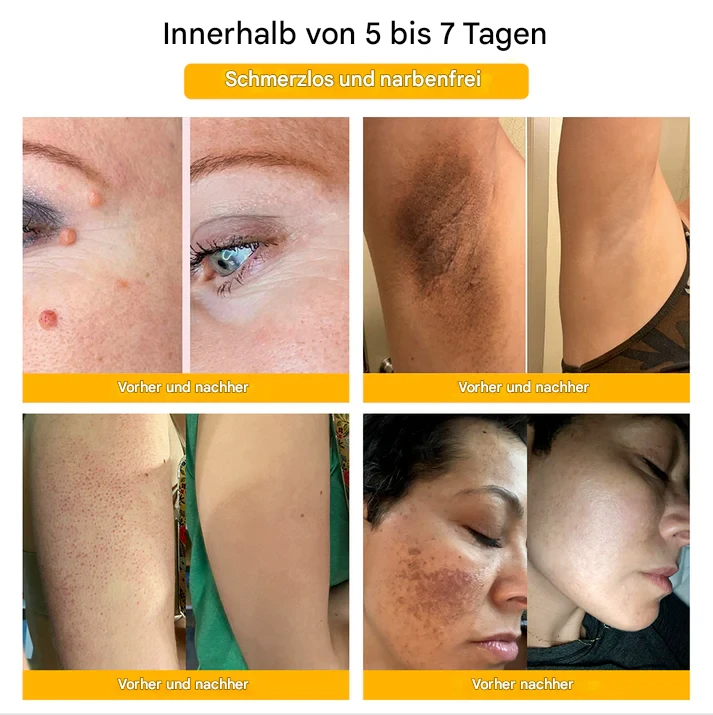 TagAway – Effektive Entfernung von Warzen und Hautwucherungen