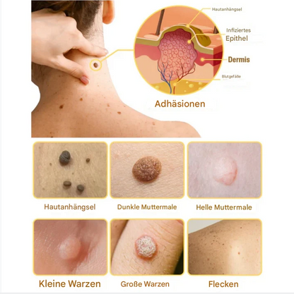 TagAway – Effektive Entfernung von Warzen und Hautwucherungen