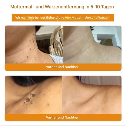 TagAway – Effektive Entfernung von Warzen und Hautwucherungen
