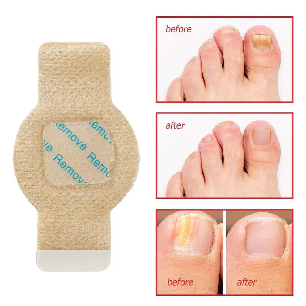 FungiCare™ - Einfach Anzubringende Nagelreparaturpflaster